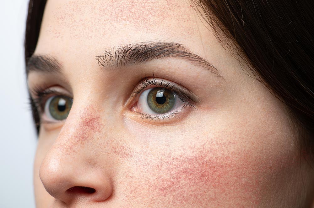 Rosacea | Couperose